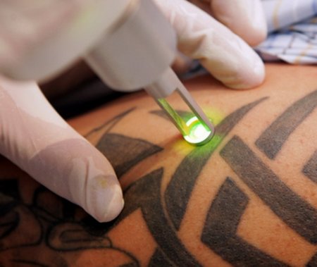 Лазерное удаление татуировок и татуажа