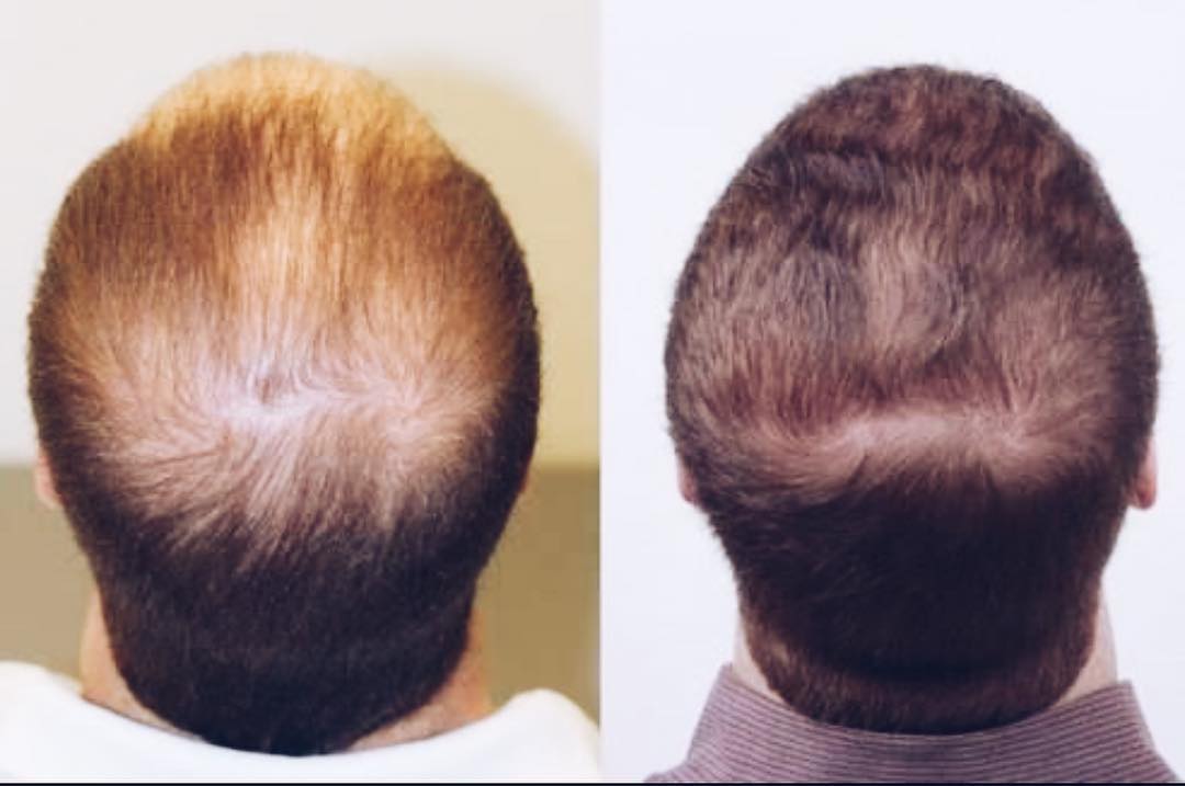 Для чего нужны волосы на голове. Плазмолифтинг для волос мужчинам. Мезотерапия для волос. Мезотерапия волос мужчин.