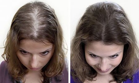 Лазерне лікування алопеції-випадання волосся